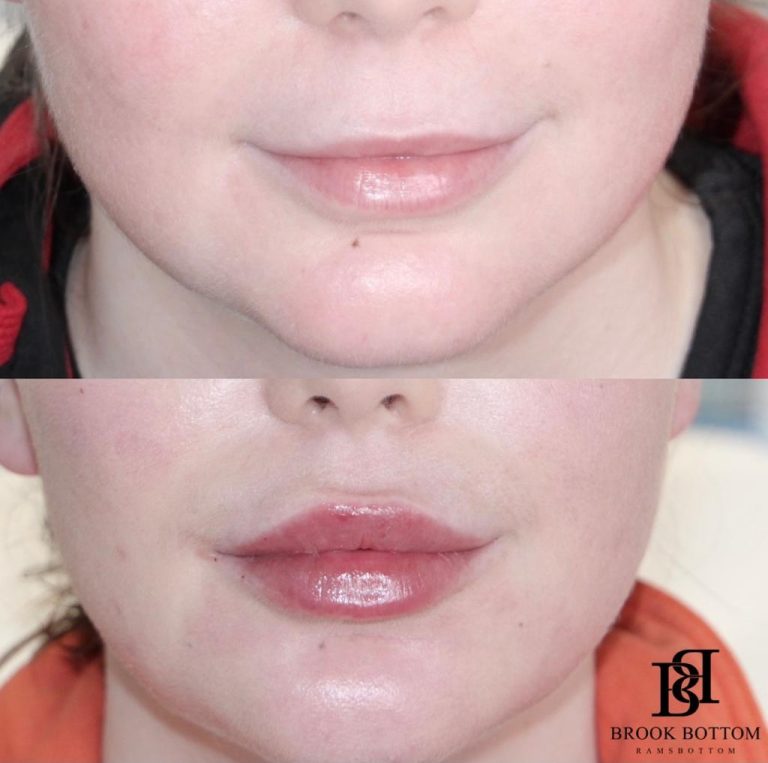 2ml-dermal-filler-lip-filler.jpg