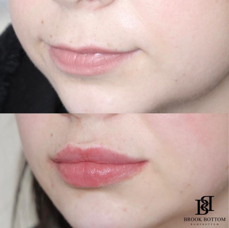 2ml-lip-filler.jpg