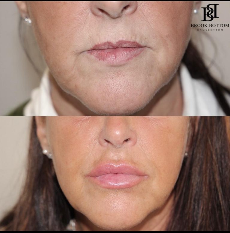 2ml-lipfiller-deb.jpg