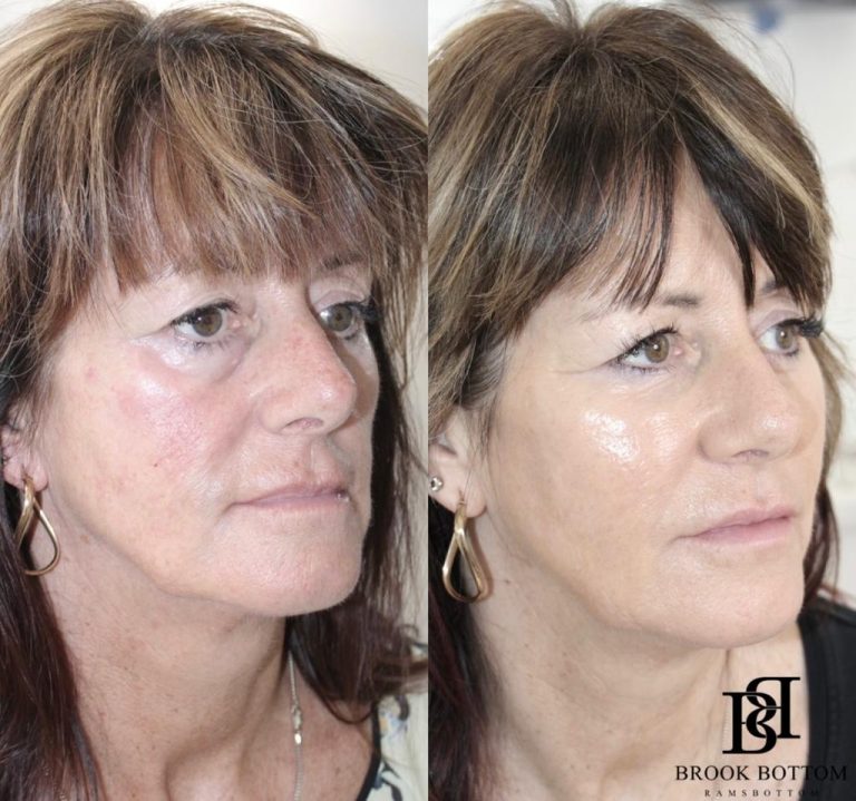 Alison-dermal-filler-rejuvenation.jpg