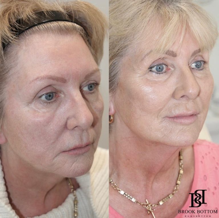 Julie-Dermal-Filler-Rejuvenation.jpg