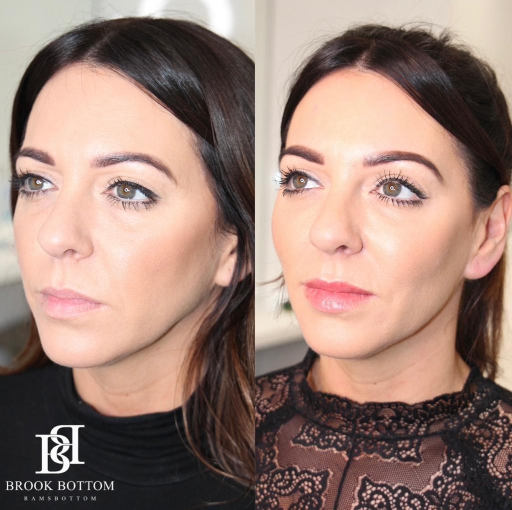 Dermal Fillers Ramsbottom & Rossendale - Brook Bottom Aesthetics