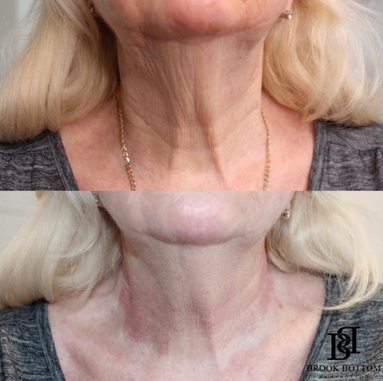 Marion-neck-lift-plasma.jpg