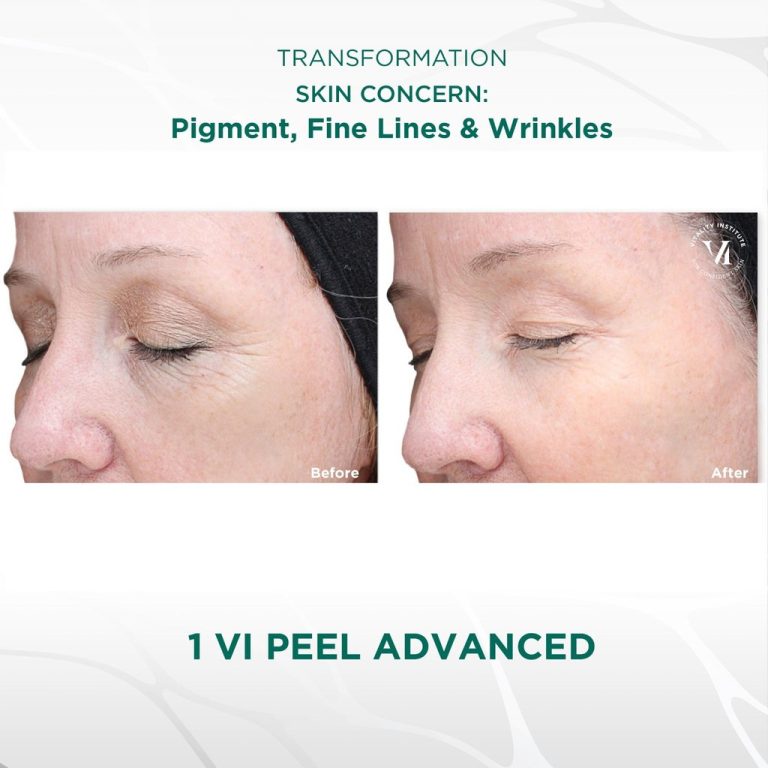 VIPeel_Advanced_BeforeandAfter2_1024x1024.jpg