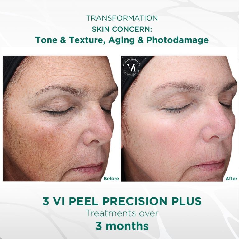 VIPeel_PrecisionPlus_BeforeandAfter_1024x1024.jpg