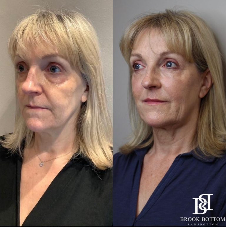 anne-rejuvenation-dermal-filler-face.jpg