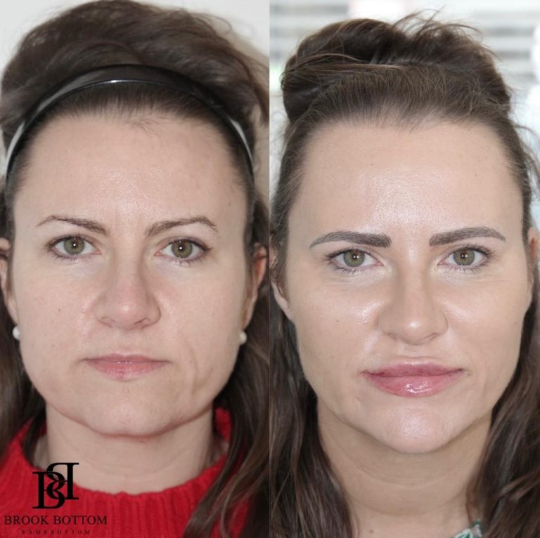 cheif-beautification-dermal-filler.jpg