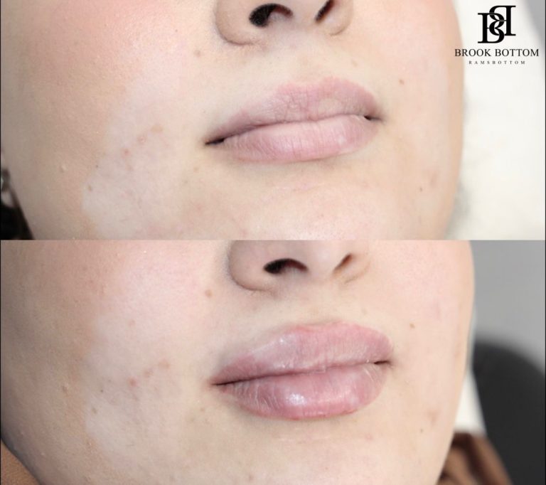 dermal-filler-1ml-lips.jpg