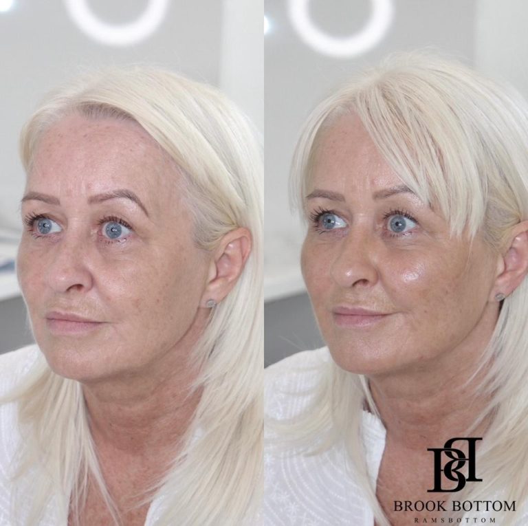 dermal-filler-rejuvenation.jpg