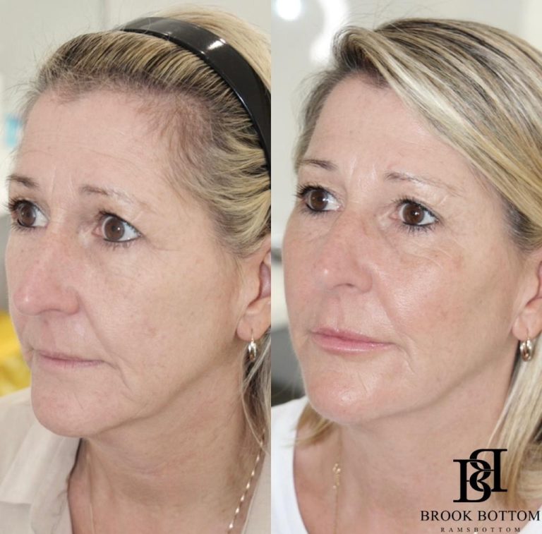 diane-dermal-filler-rejuvenation.jpg