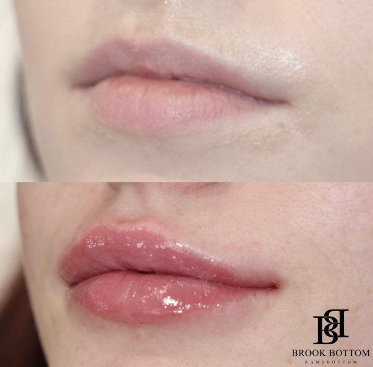 gemma-lip-filler-1ml.jpg