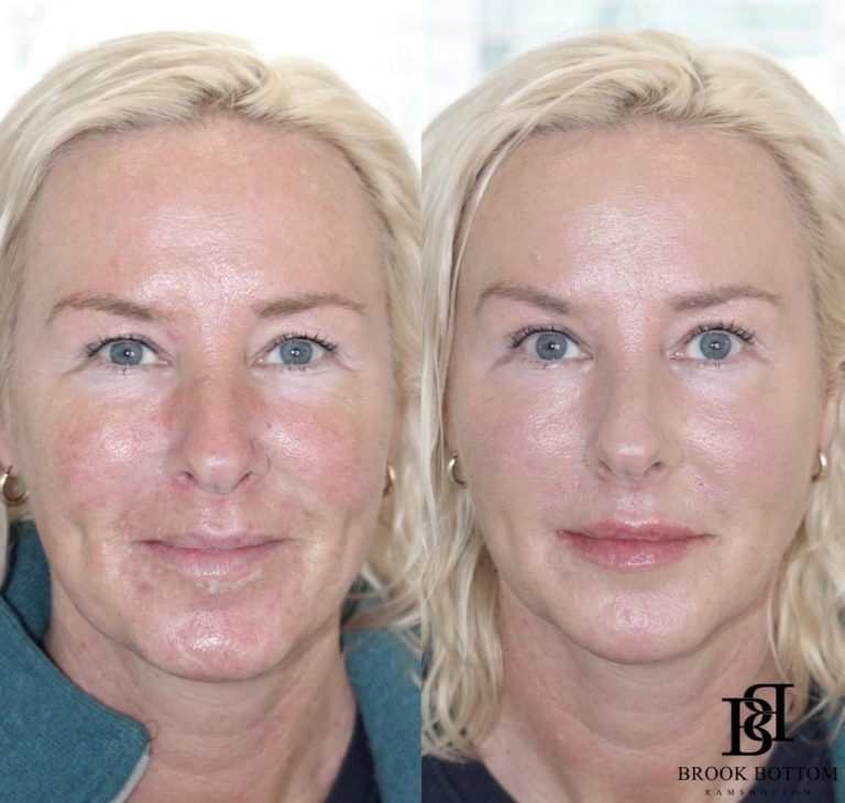 jess-dermal-filler-rejuvenation.jpg