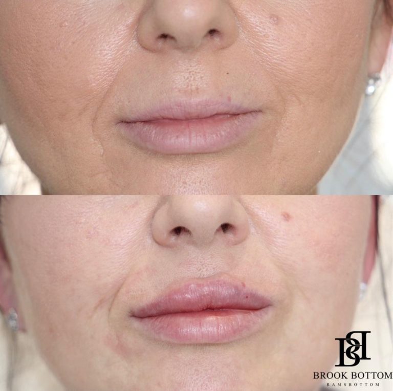 linda-1ml-lip-filler.jpg