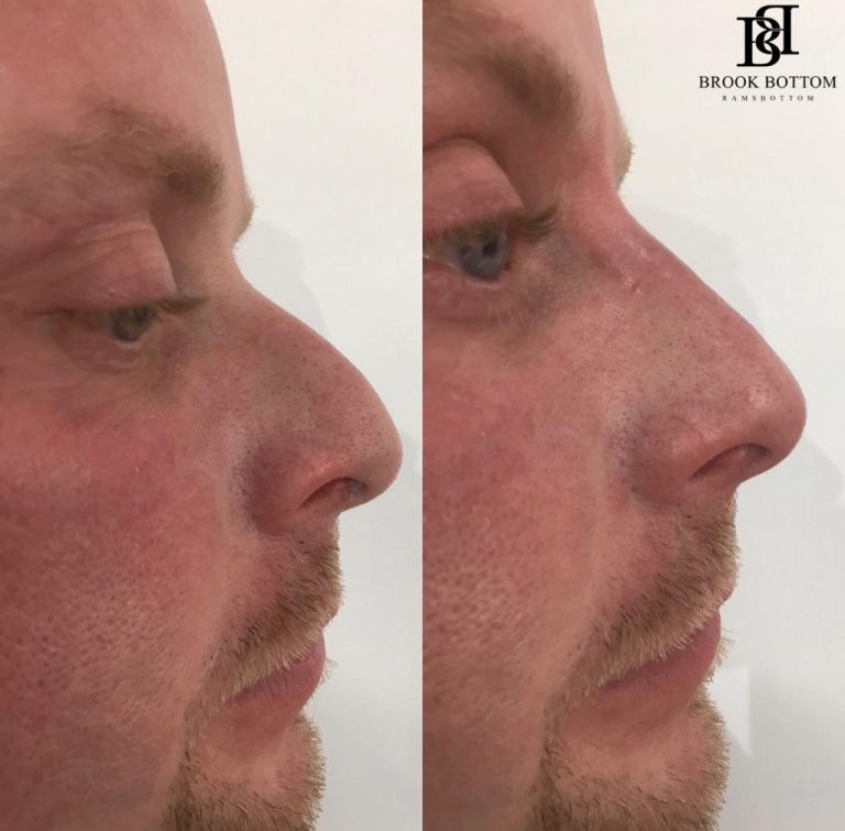 non-surgical-nose-filler.jpg