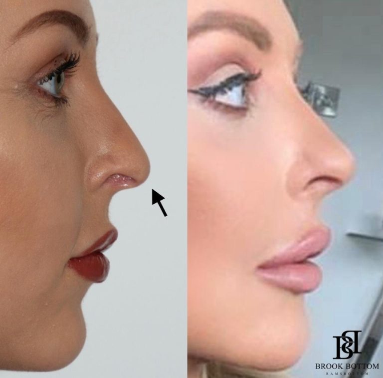 nose-dermal-filler.jpg