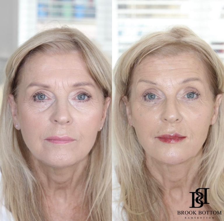 rejuvenation-dermal-filler.jpg