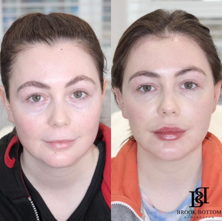 rhiannon-dermal-filler-lowerface-1.jpg