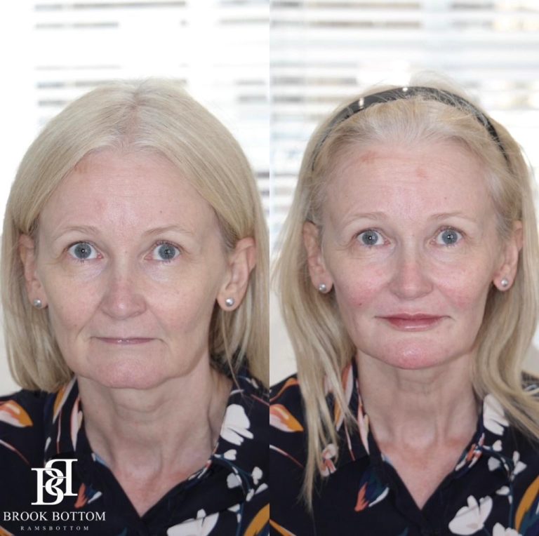 tracey-dermal-filler-rejuvenation.jpg