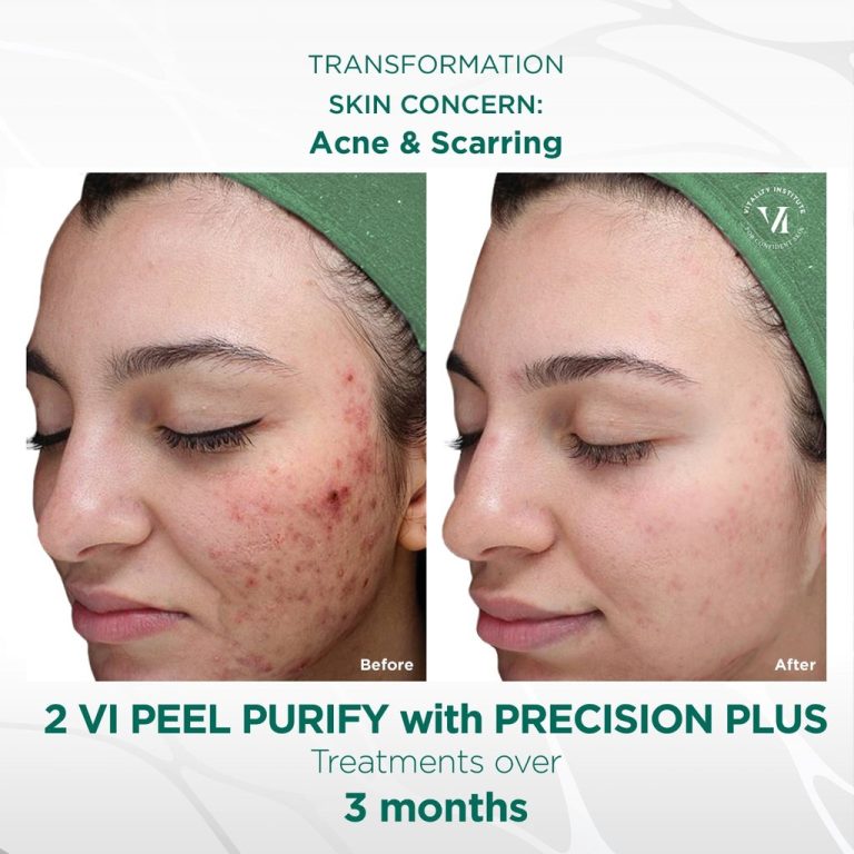 vi-peel-acne.jpg