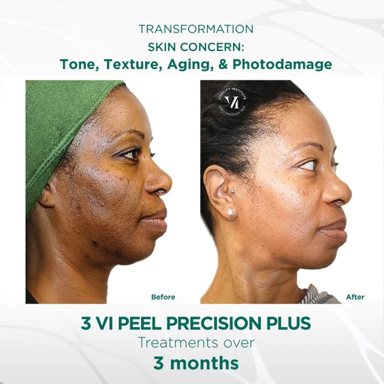 vi-peel-aging-tone-texture.jpg