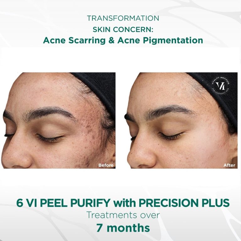 vi-peel-purofy-precision-plus.jpg